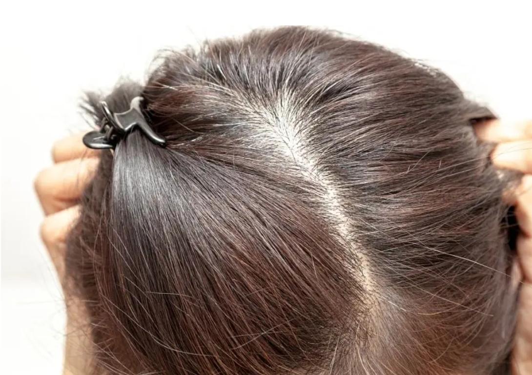 头皮里总是长疙瘩和脓包怎样治疗,头皮总长疙瘩和脓包是怎么回事