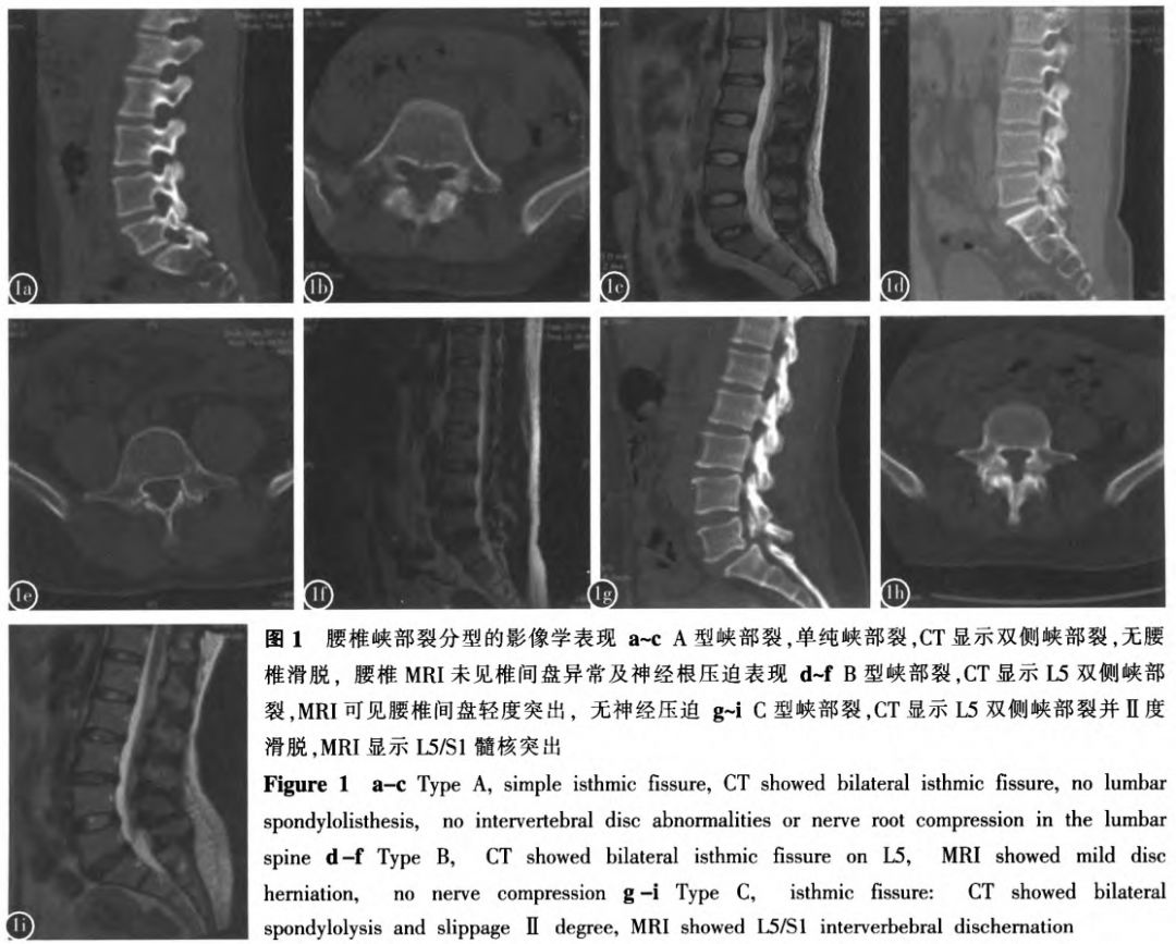 轻度峡部裂和重度峡部裂的区别,真性峡部裂和假性峡部裂