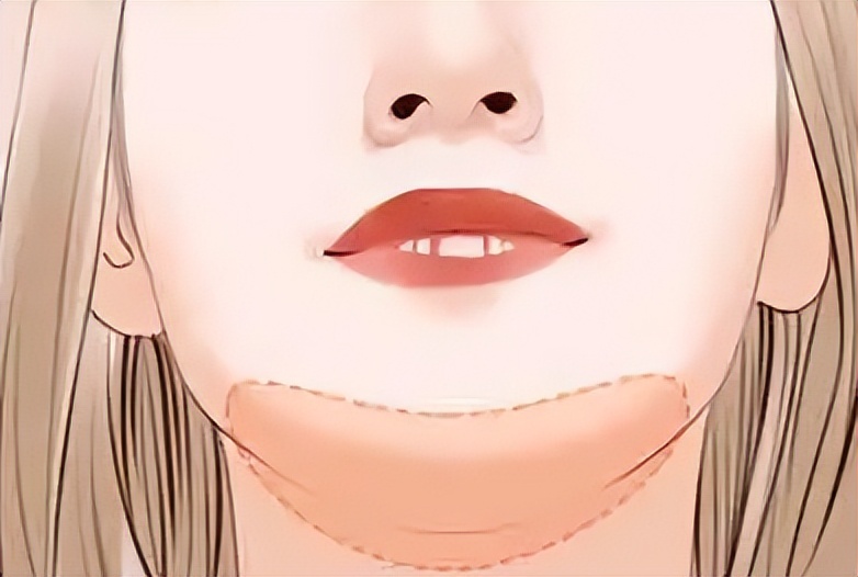 九院韦敏面部吸脂,九院韦敏植骨手术案例