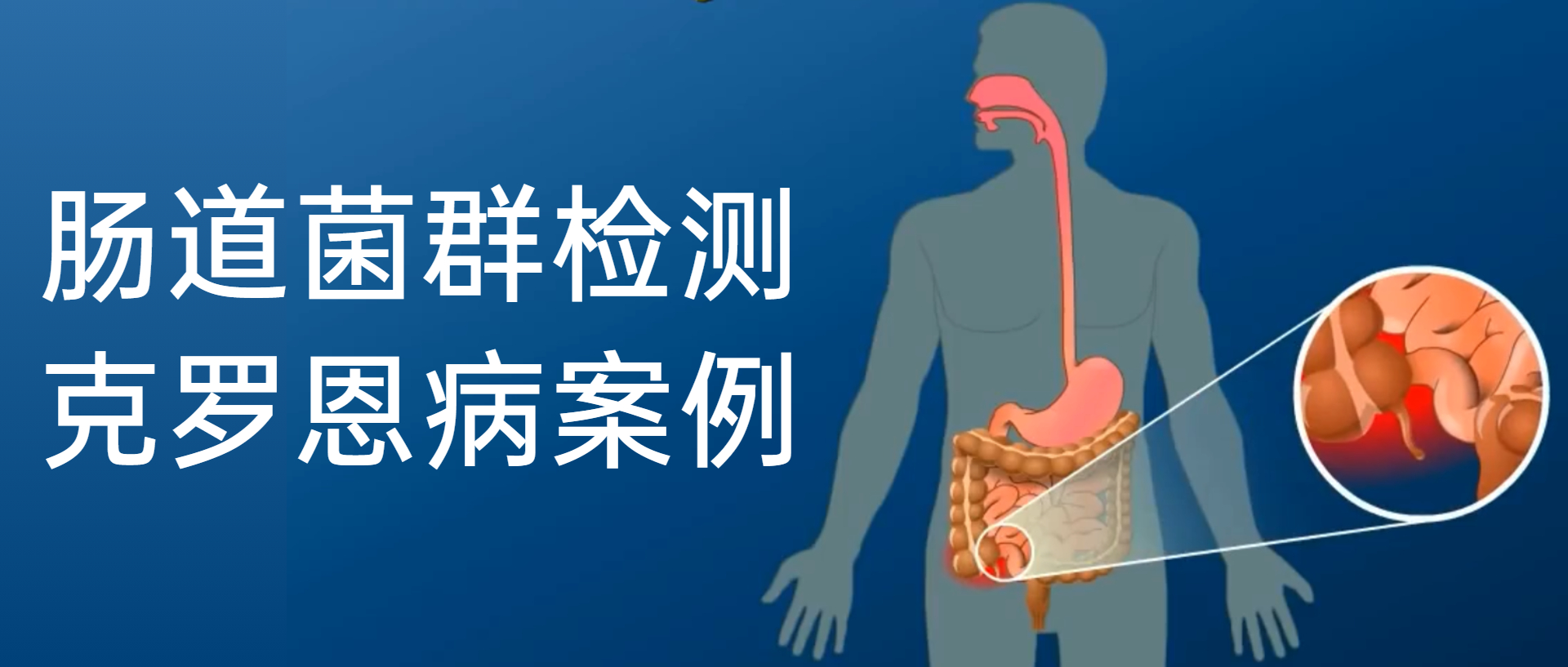 克罗恩病诊断病例,克罗恩肠道菌群移植术全过程