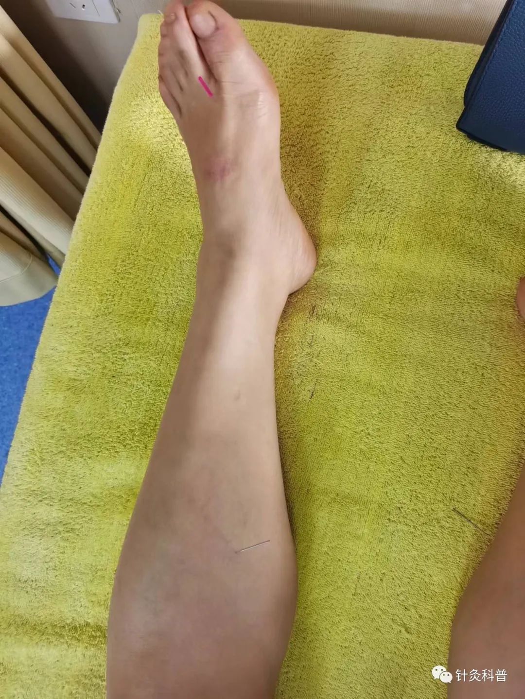 皮肤湿疹可以针灸治疗吗,针灸治疗脸上湿疹的绝招