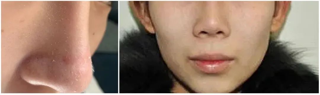 10秒治鼻炎,鼻炎5秒通鼻最快的方法