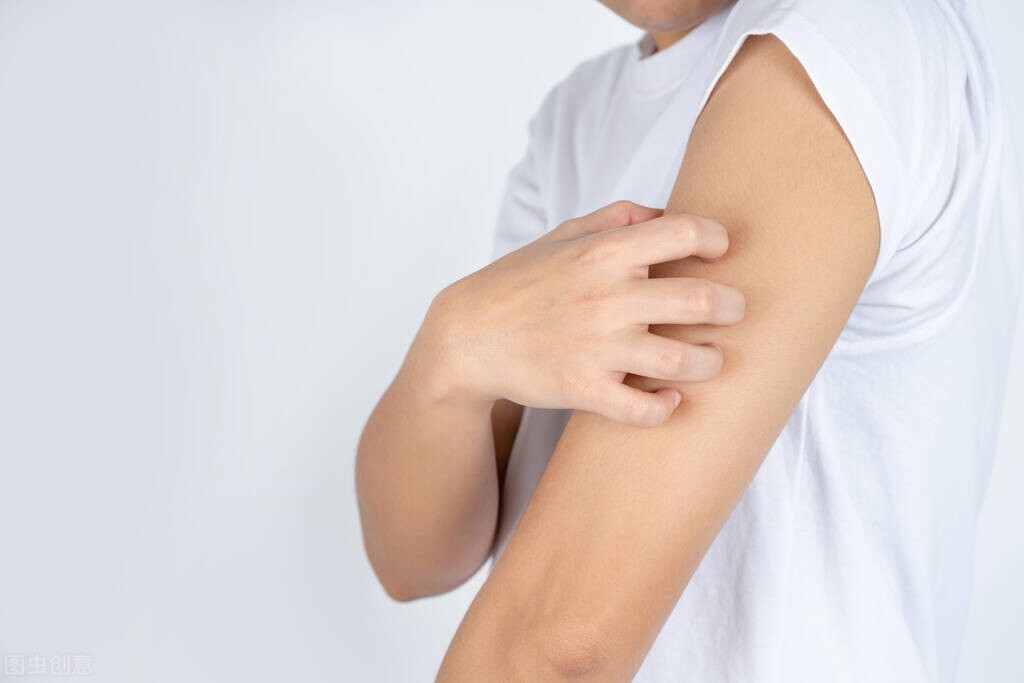 荨麻疹反反复复遇热就严重,麻疹越挠越多