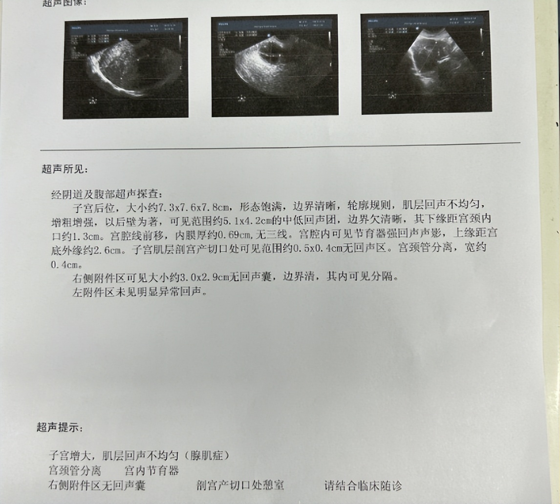 子宫腺肌症二次带曼月乐环后，她最终来做了保宫手术