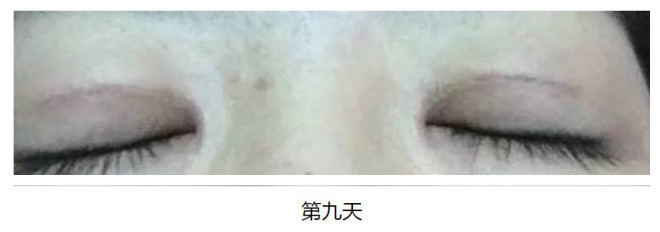 全切双眼皮术后下唇出现多层褶皱,为什么双眼皮术后反而遮瞳孔了