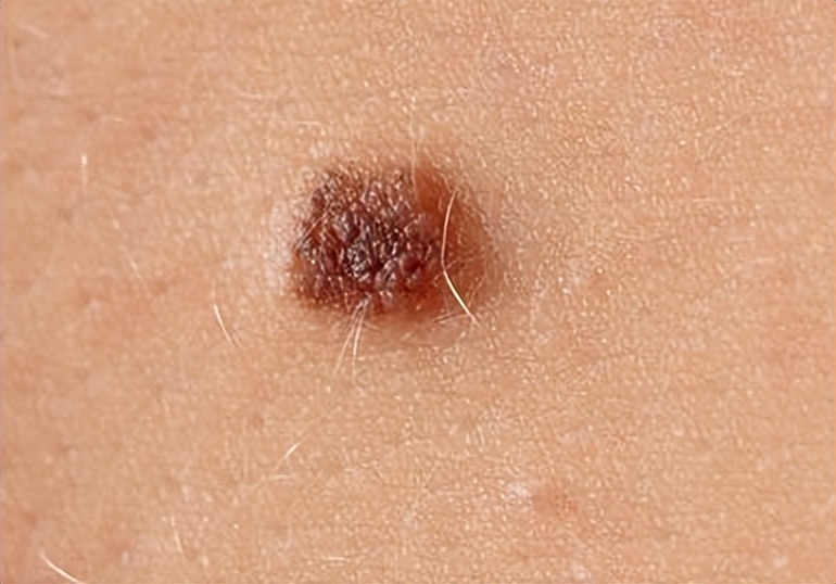 黑痣长在脸上各部位代表什么图片,医生说黑痣有癌变的可能怎么办