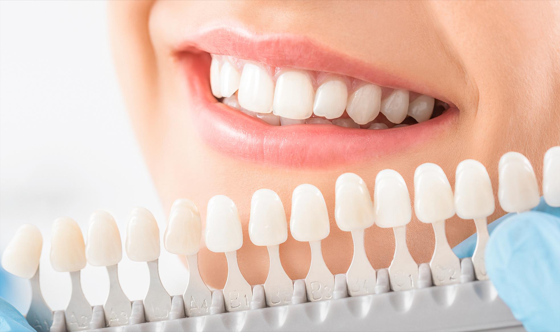 牙齿贴面的材料和品牌区别,牙贴面品牌十大排名最新