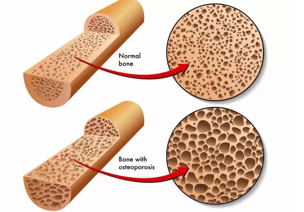 儿童骨密度检测中bmi正常范围,34岁骨密度检测说骨质疏松怎么办