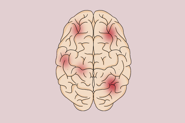 脑萎缩时身体一般会出现3种反应,大脑开始萎缩身体出现什么现象