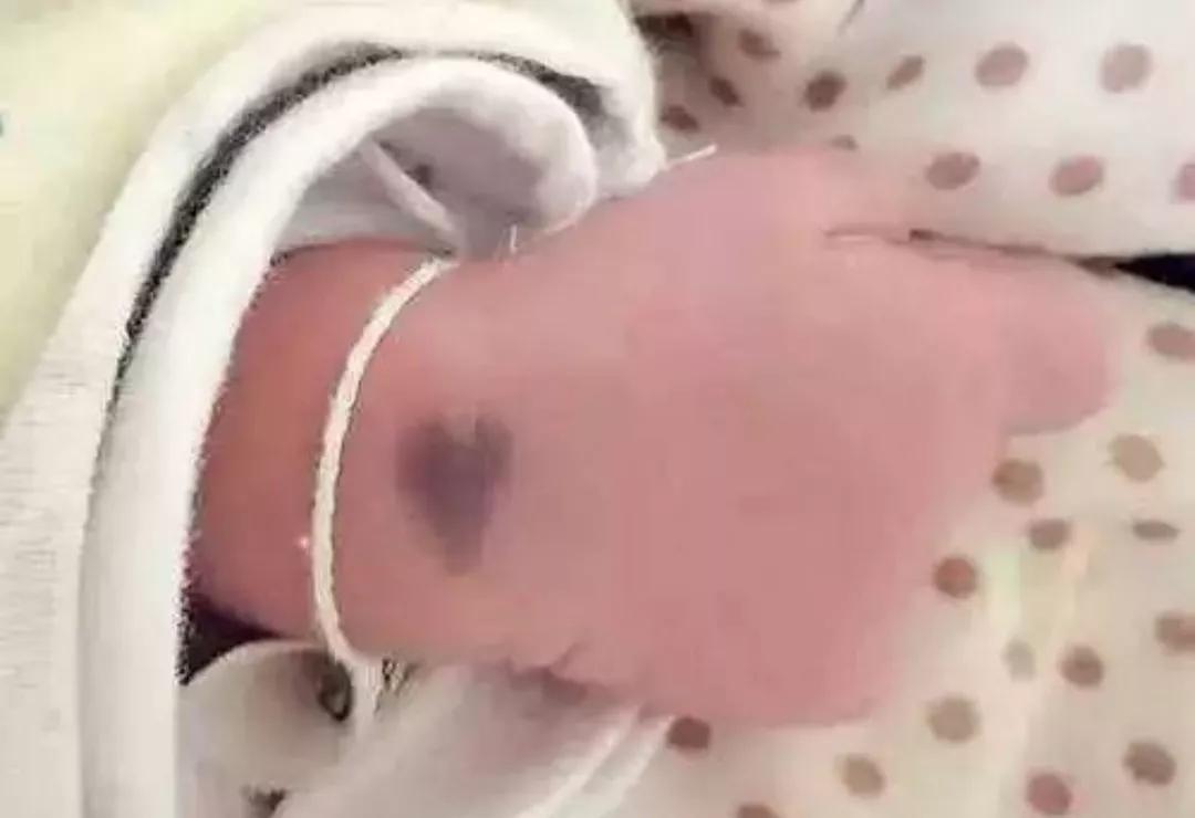 宝宝身上的胎记怎么形成的,怎么避免胎儿长胎记