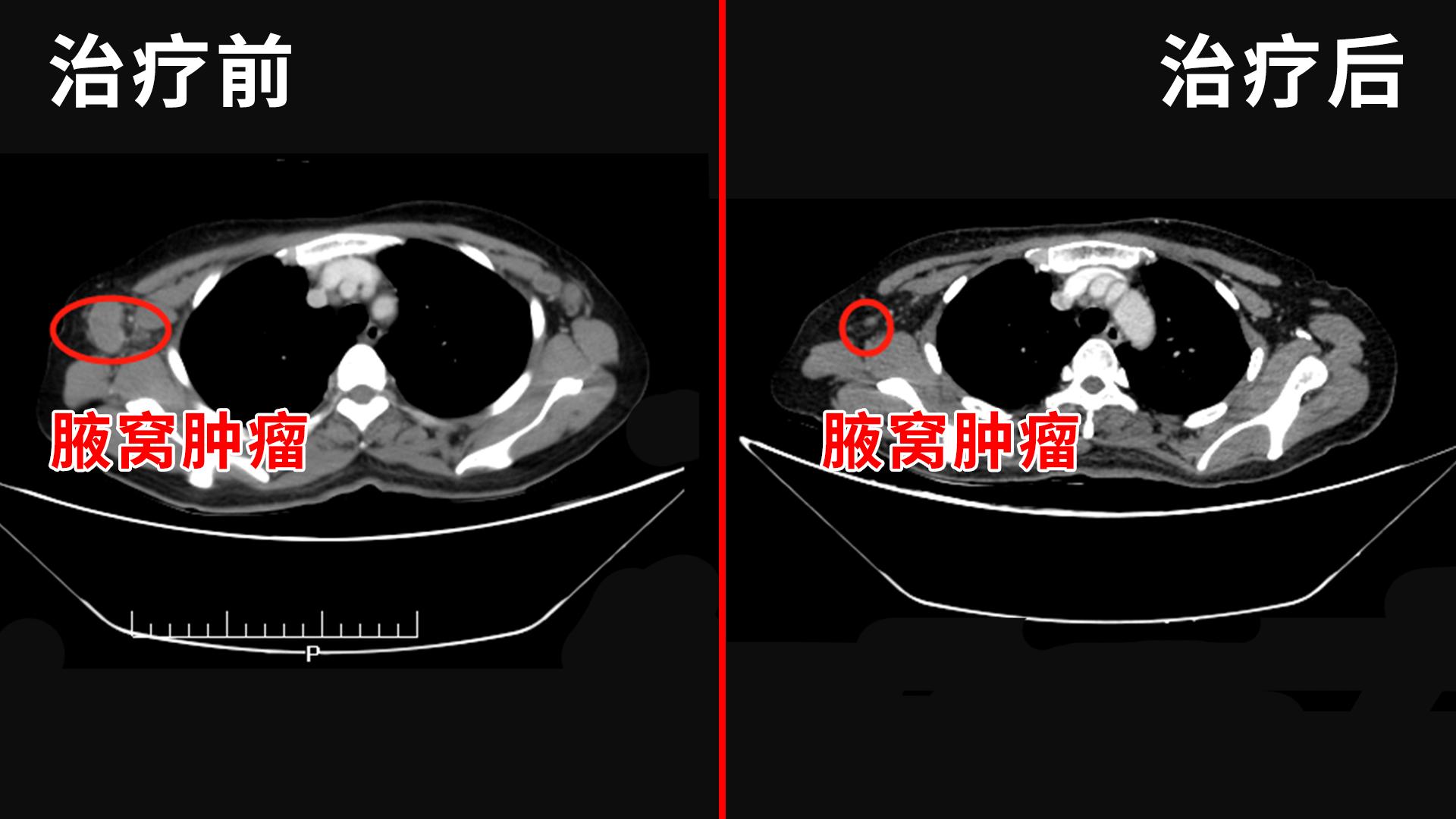 乳腺癌乳房破溃介入治疗,乳腺癌破溃后流脓能治愈吗