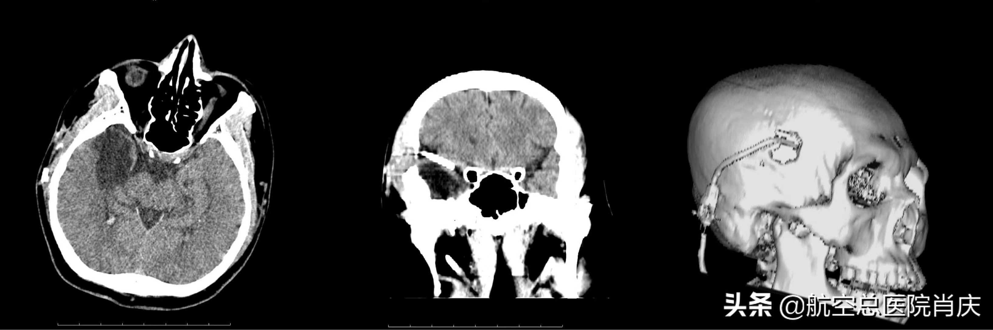 脑分流手术后头疼怎么回事,脑部分流手术后一直吐