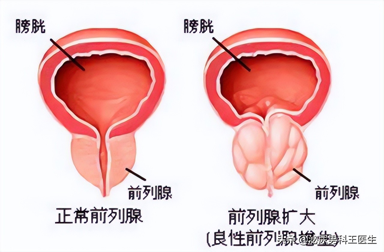 治疗前列腺增生最好的三种药,前列腺增生药物控制好还是手术好