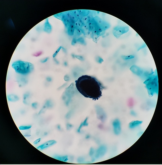 tct手机上可看到报告吗,妇科tct报告如何解读