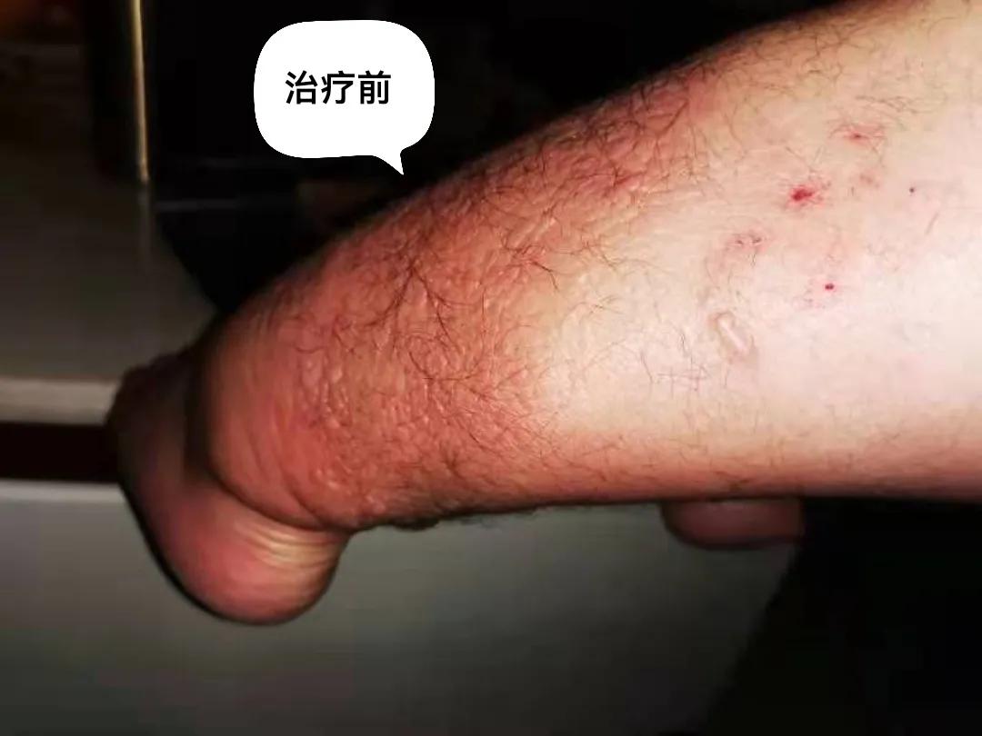 胫前骨粘液性水肿局部治疗,胫前粘液性水肿病例