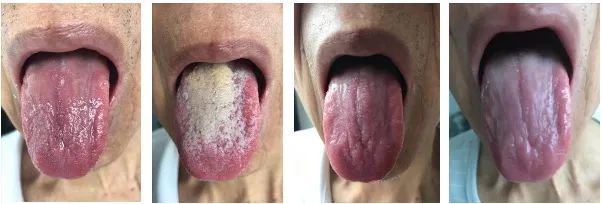 漫漫抗癌成功案例,漫漫抗癌路