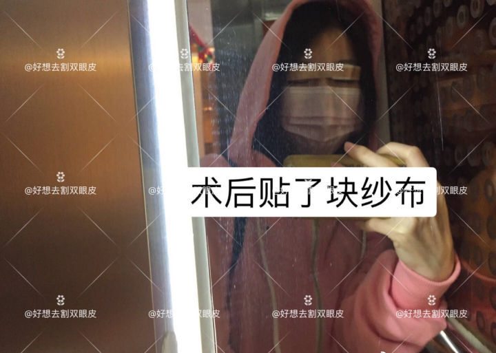 广州姑娘变美后亲述：“我的双眼皮切得很小，只有1厘米多一点”