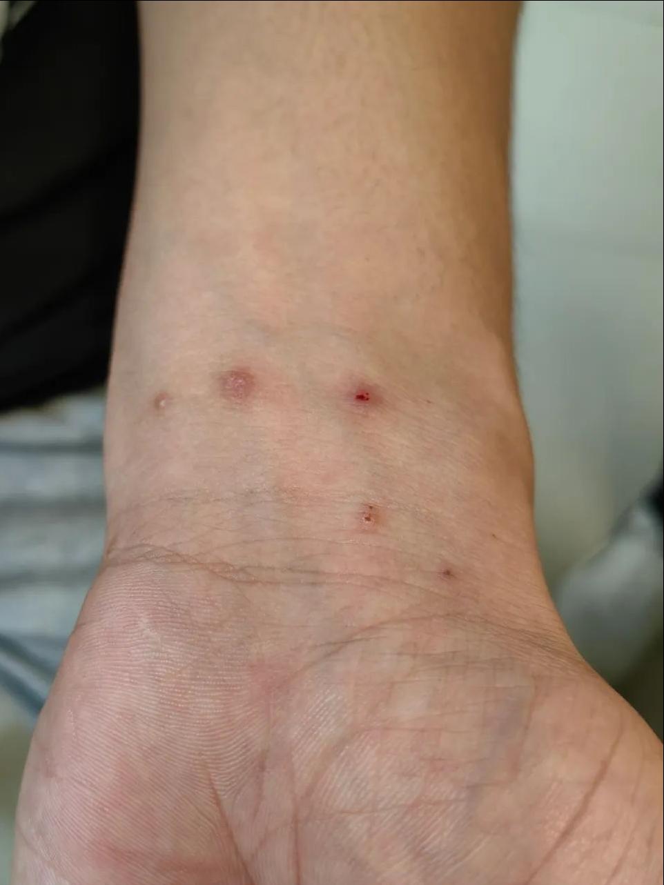 脖子前边痒是生病的前兆,腋窝和脖子痒是什么病的前兆