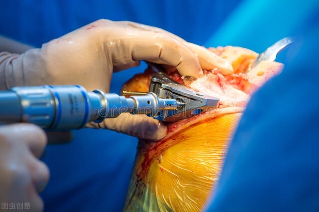 人工膝关节置换手术后，一个月时间里度日如年