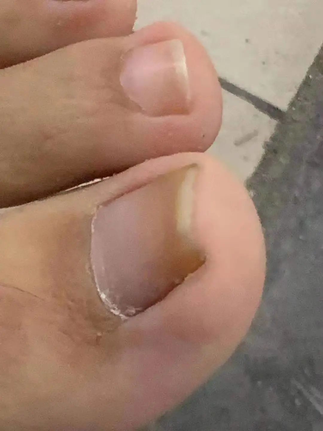 嵌甲疼痛难忍,嵌甲怎么才能有效缓解疼痛