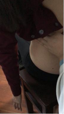 腰椎侧弯腰痛吃什么药,臀肌筋膜炎导致腰椎侧弯