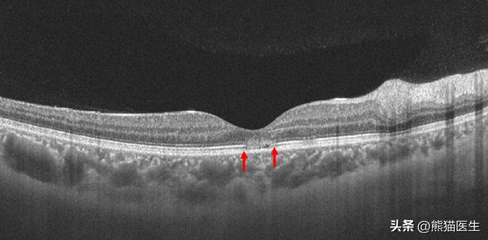 阳了一周之后眼睛模糊是后遗症吗,阳后出现眼部症状会怎样