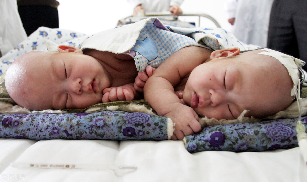 连体姐妹一人结婚现在如何,雌雄连体人结婚怎么办