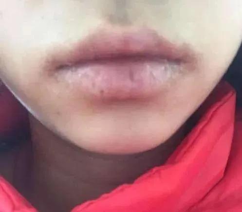 因为涂口红导致过敏视频,涂口红嘴唇发炎