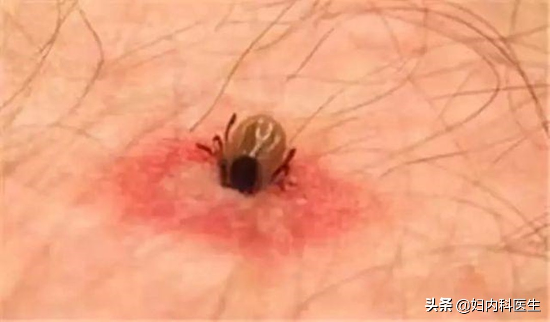 河南频繁有人因蜱虫病去世，蜱虫病到底是何病？为何致人于死地