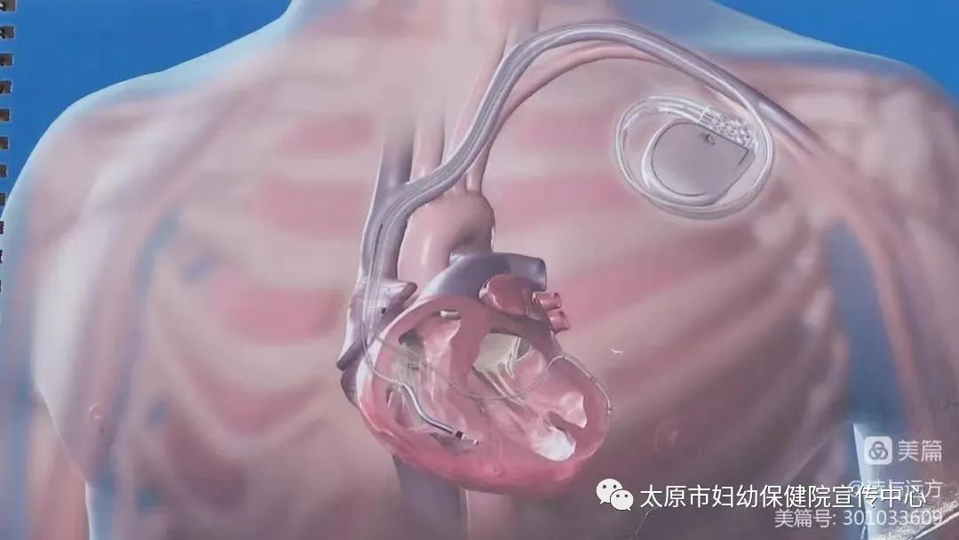 心脏起搏器植入山西哪家医院好,太原市心血管医院心脏起搏器