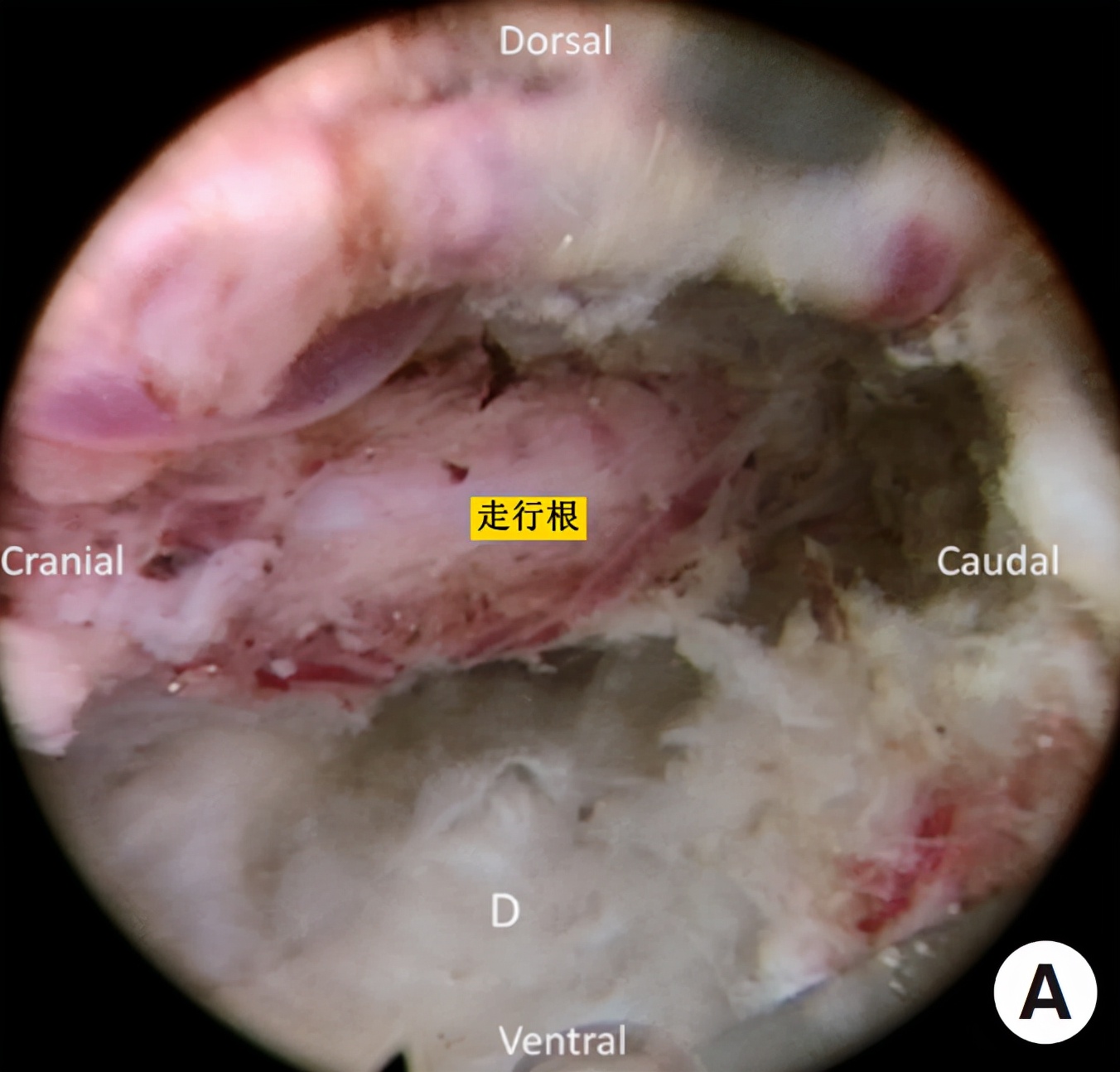 椎间孔镜微创介入治疗椎间盘突出,腰3-4椎间盘突出针刀治疗