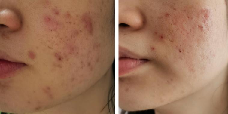 30岁女性满脸爆痘怎么治,按疗程治疗反复爆痘正常吗