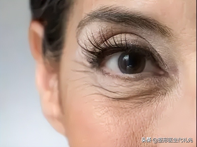 眼下细纹除皱教程,眼下细纹怎么去除做手术