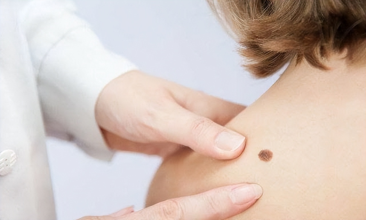 黑痣与肉痣长什么位置不能取,身上黑痣白痣红痣图片