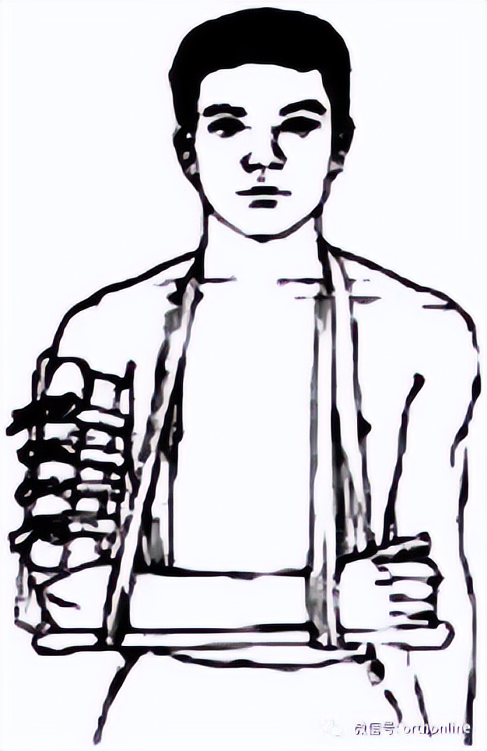 肱骨干骨折髓内钉手术记录,肱骨干骨折康复训练全套视频