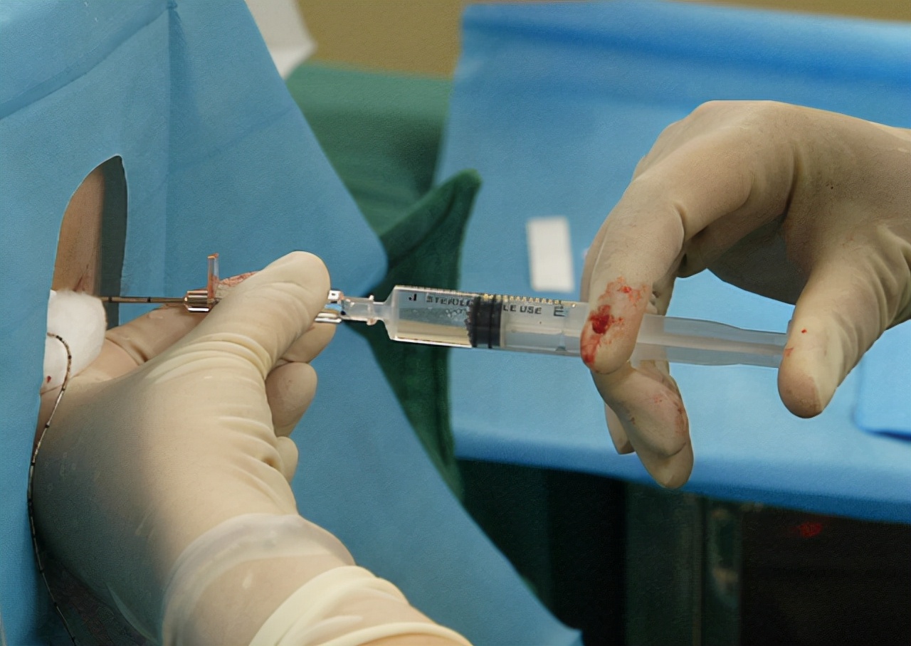 局部麻醉几次相当于全麻,全身麻醉是跟死过去一样吗