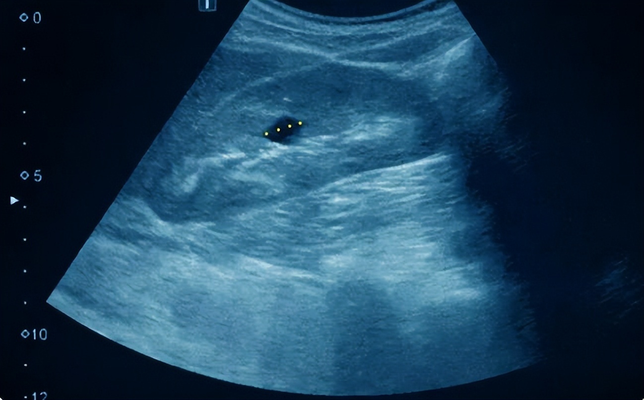 医生说有小囊肿要注意什么,囊肿刚开始长有什么办法消除吗