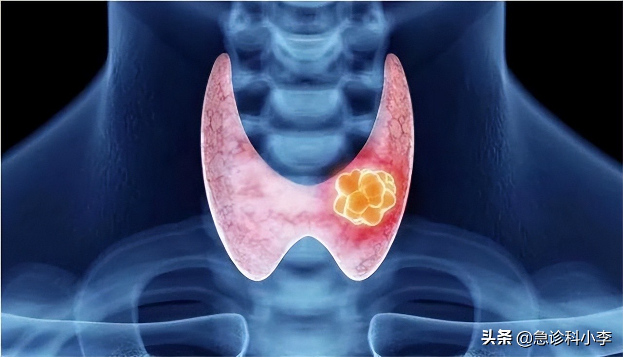 甲状腺结节伴有甲亢最好治疗方法,检查出甲状腺结节怎么办