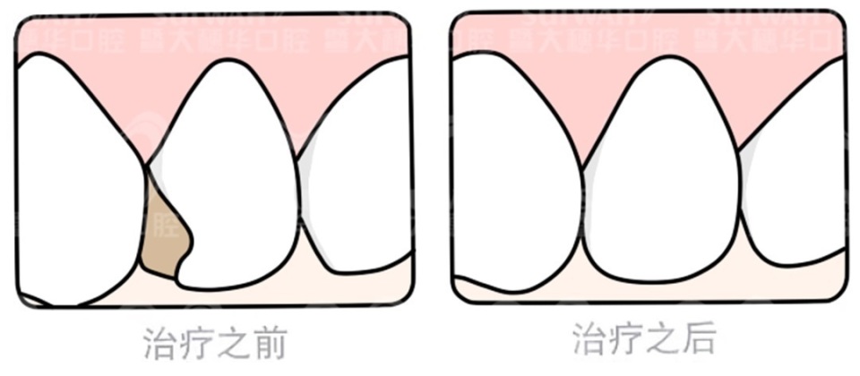 中山大学附属口腔医院牙缝修复,苏州华夏口腔修复牙缝