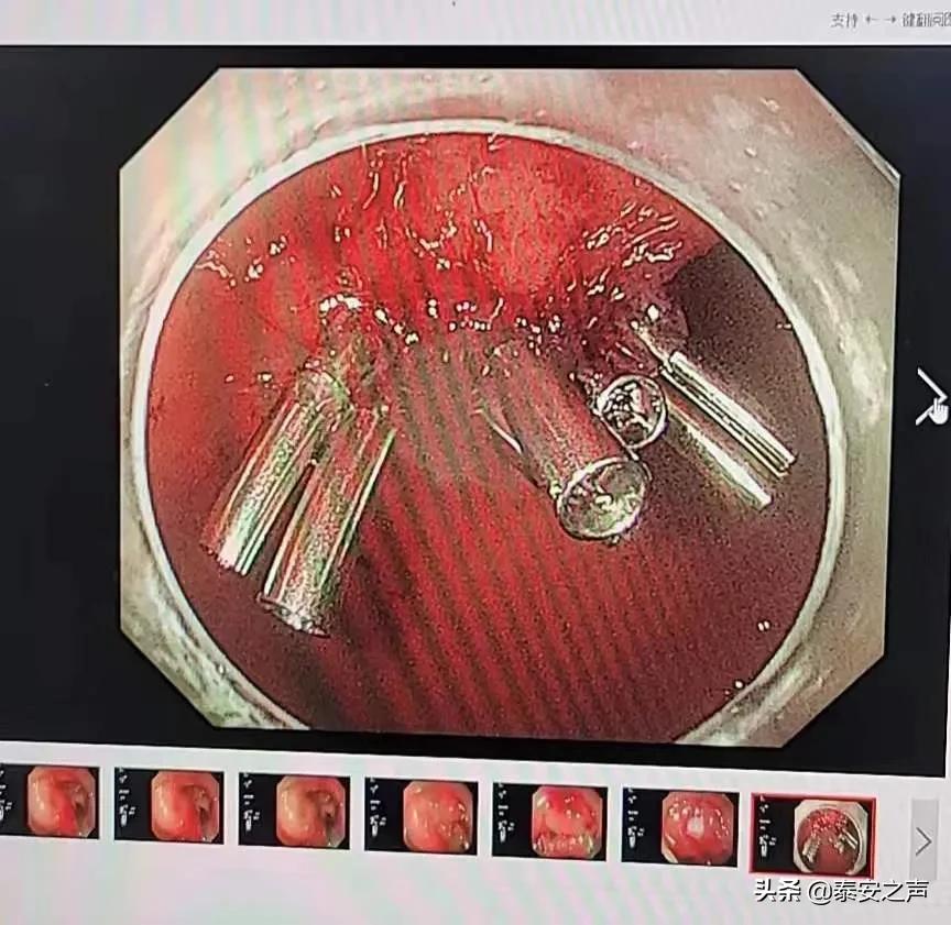 惊了！保胆取石取出164枚结石！这个团队是怎么做到的