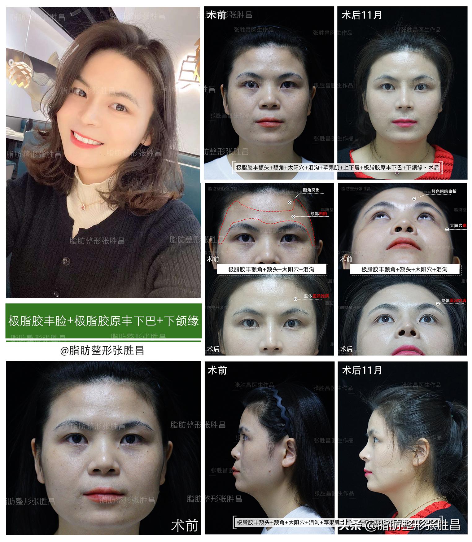 做过脂肪填充的视频,作为做过眼袋手术的过来人