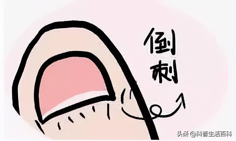 长倒刺说明啥,长倒刺吃什么好