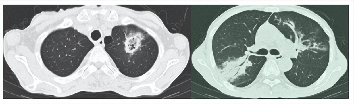 肺部长蘑菇是什么病,肺部有蘑菇结节