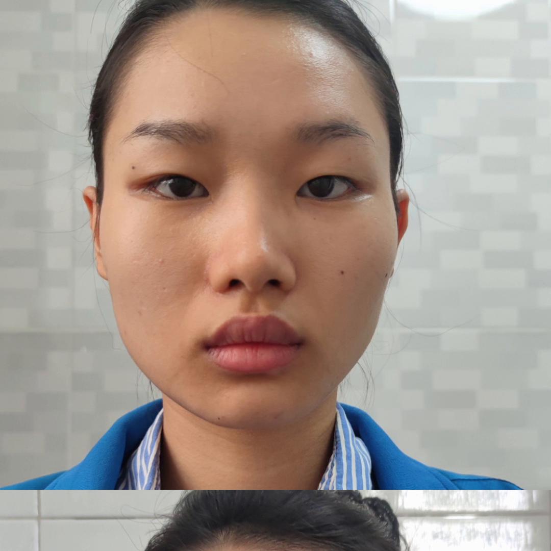 脸颊凹陷怎样练变圆润,脸颊凹陷怎么变平整