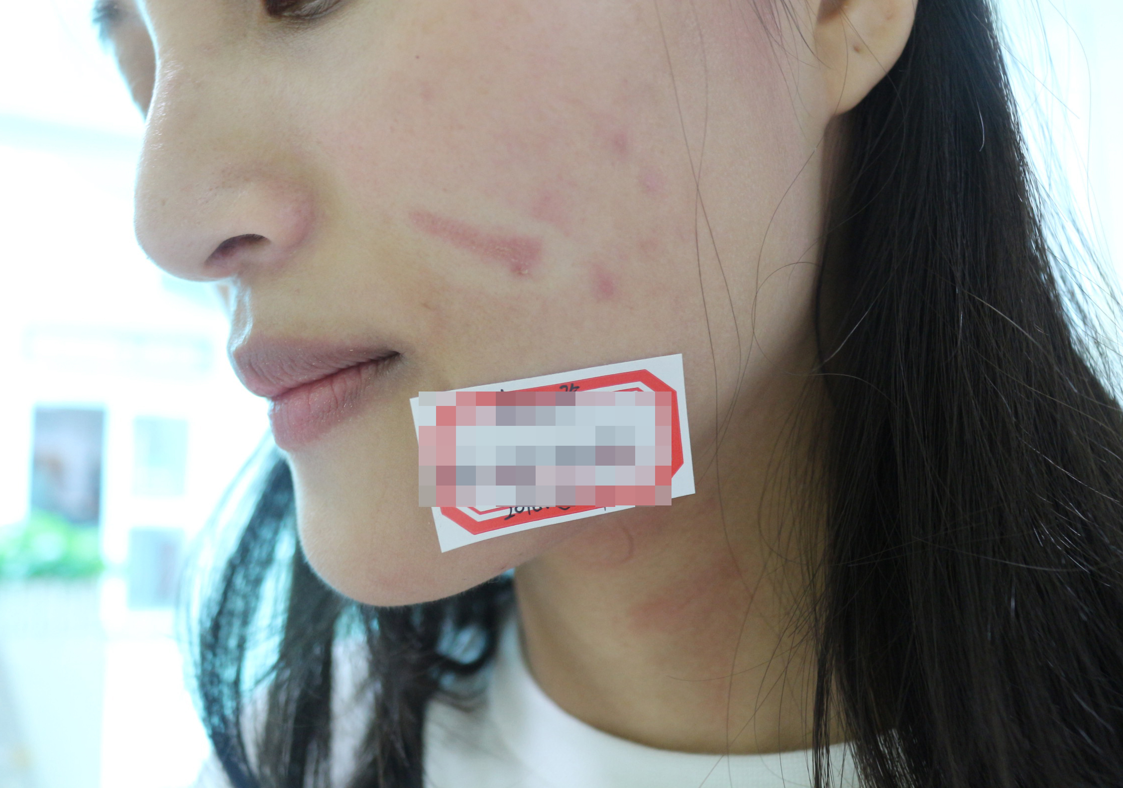 河南疤痕排名医院？哪家医院去红色疤痕？