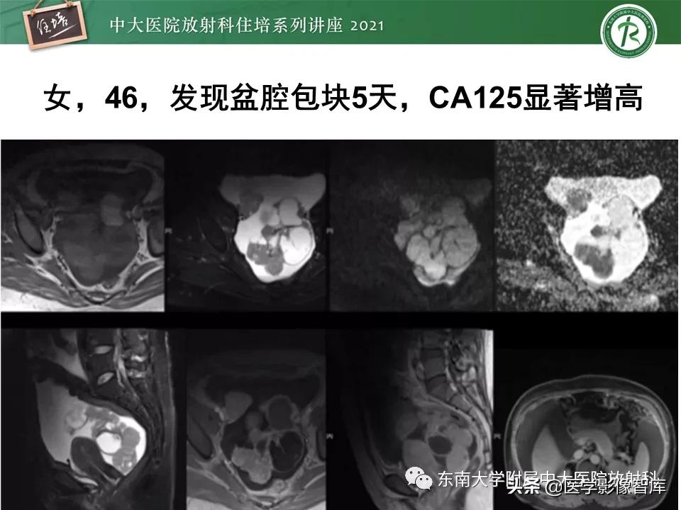 卵巢浆液性肿瘤的肉眼及镜下特征,卵巢原发性粘液性囊腺瘤