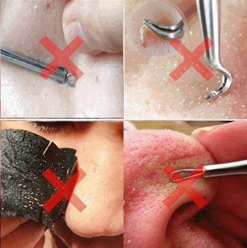 额头眉心发红有闭口粉刺,眉心鼻头频繁起粉刺怎么办