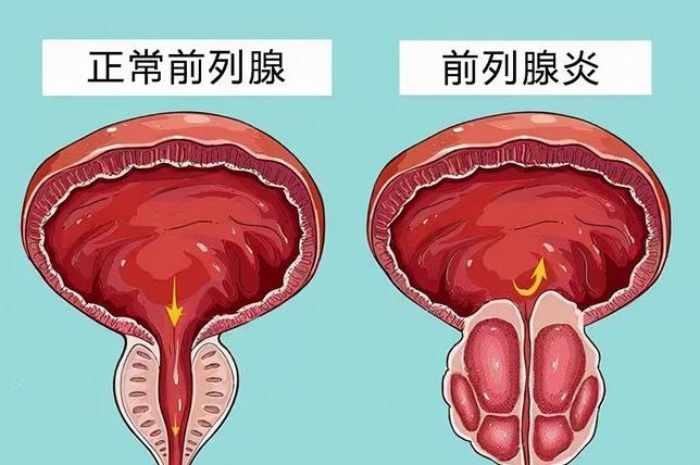 前列腺受损,治疗前列腺疾病有什么最新方法