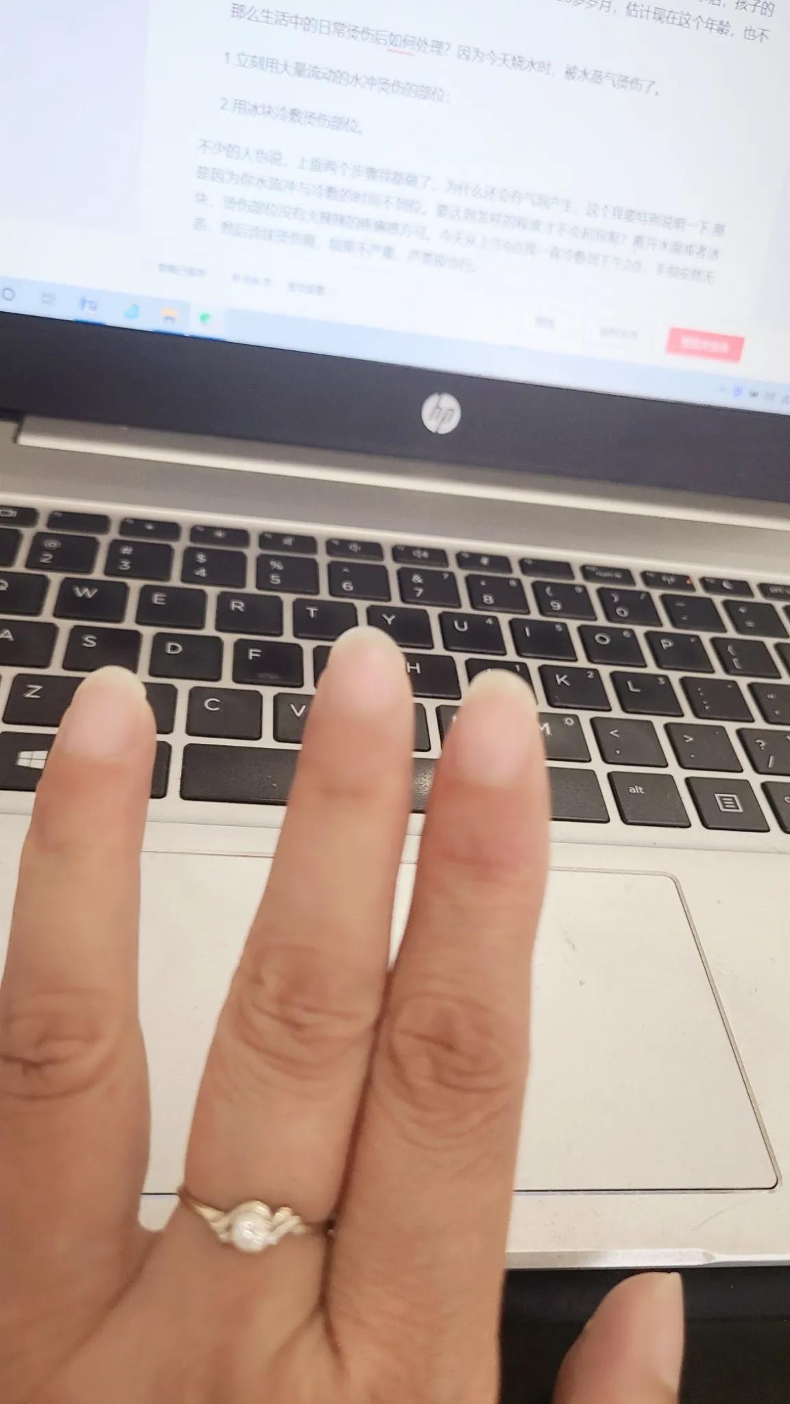 正确处理烫伤或烧伤的方法是,烫伤了怎么知道有没有发炎