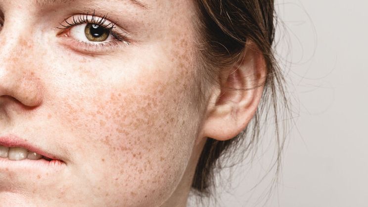 脸上的斑一大片一大片的是什么斑,斑的图片脸上长斑要吃什么药调理